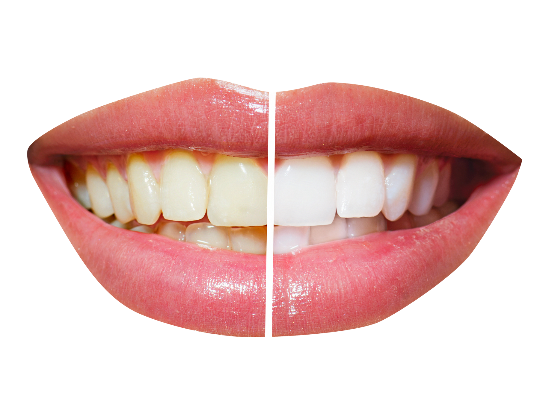 Teeth Whitening PNG Transparent Image   HD Free Download